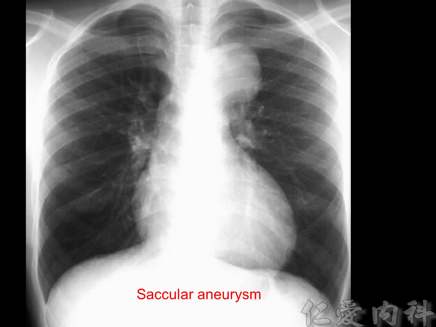 胸部x光解析 纵膈病灶 chest x-ray interpreta