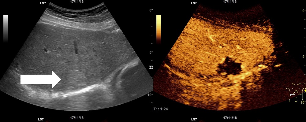 00_Featured_Images - liver_hemangioma_sonography.jpg