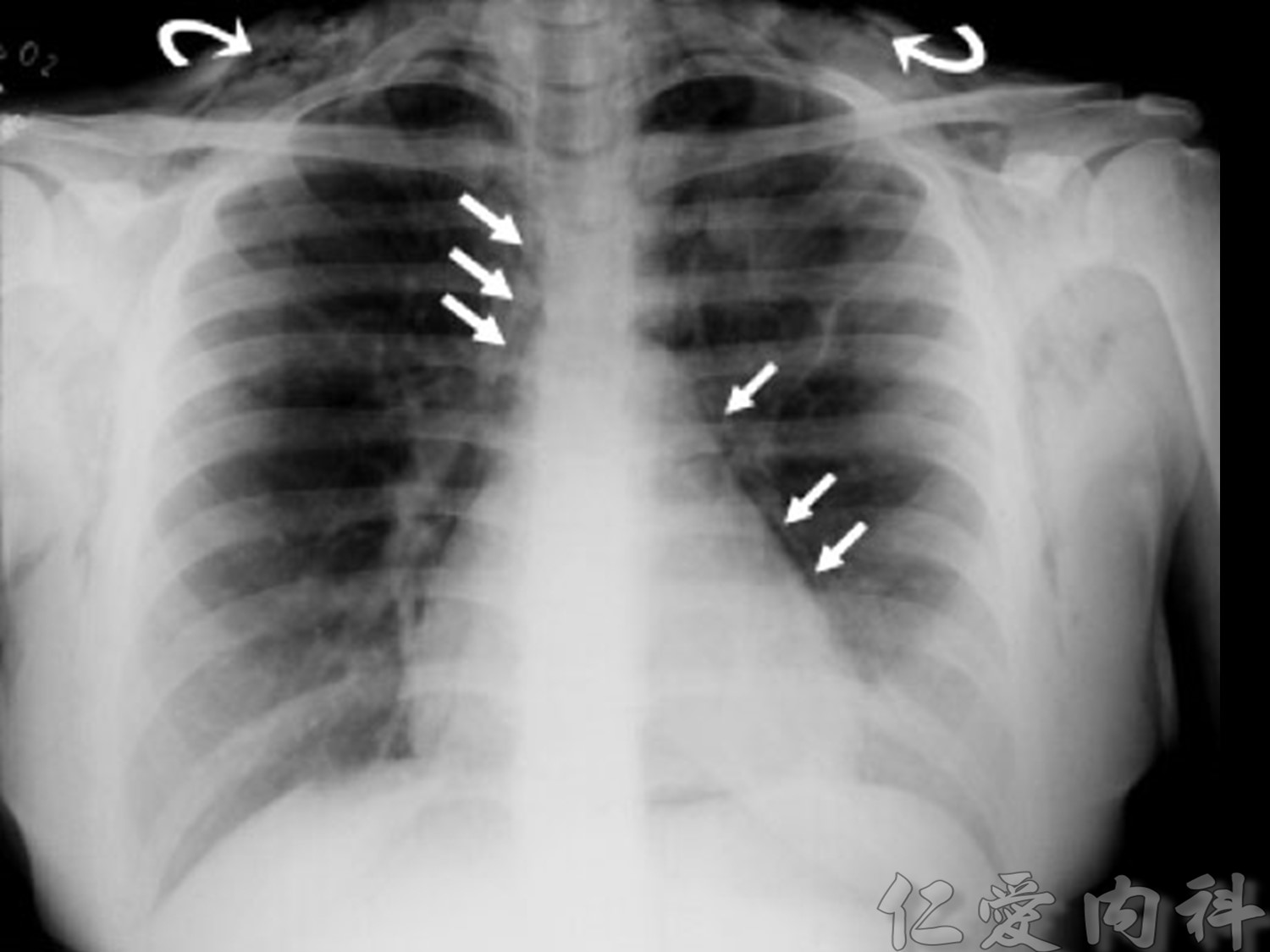 mediastinal_mass - mediastinal_mass-12.jpg