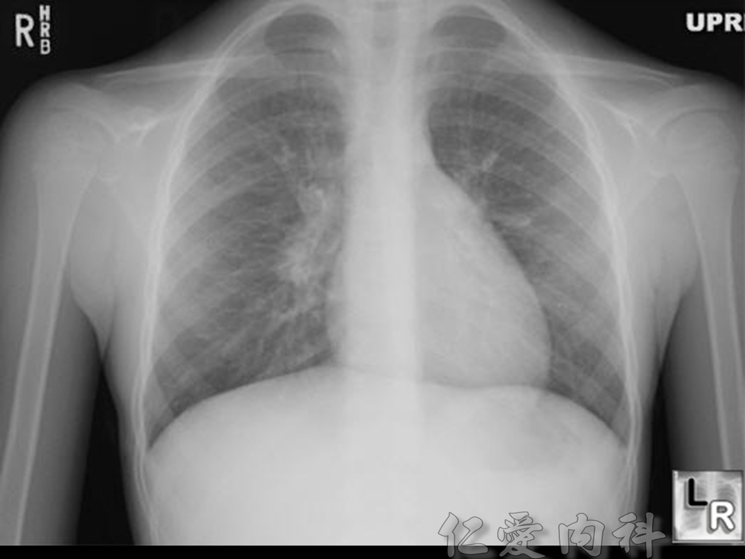 mediastinal_mass - mediastinal_mass-13.jpg