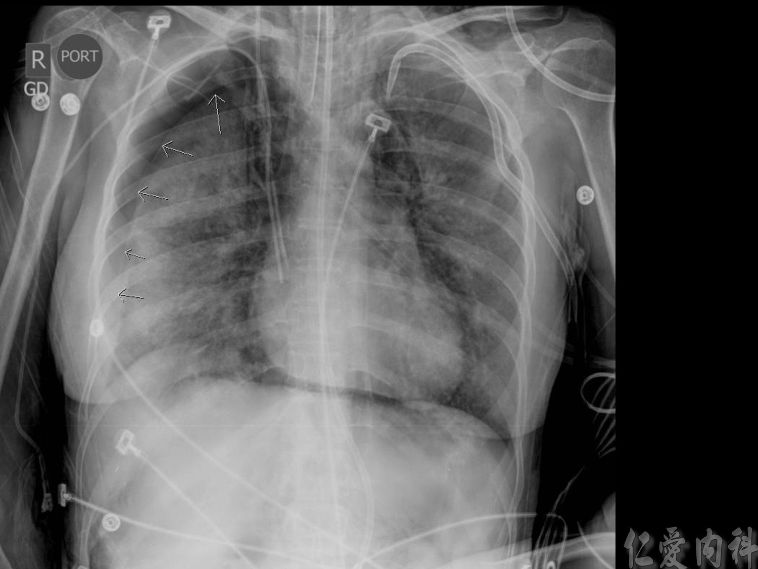 mediastinal_mass - mediastinal_mass-14.jpg