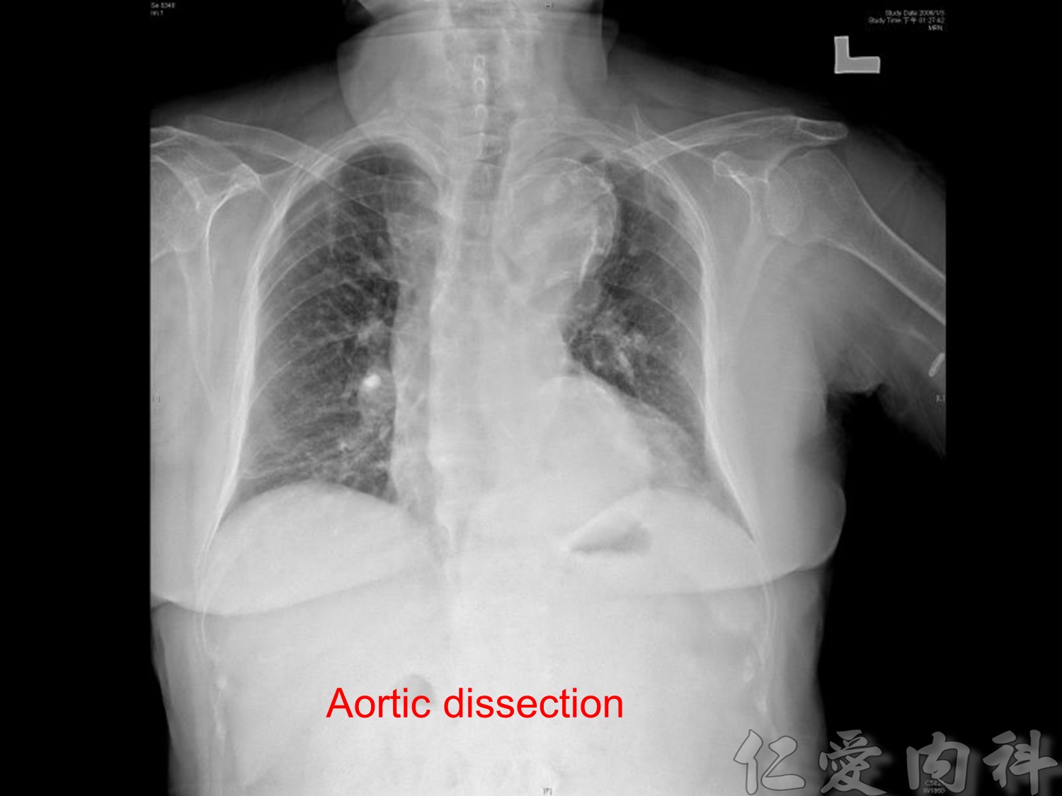 mediastinal_mass - mediastinal_mass-18.jpg