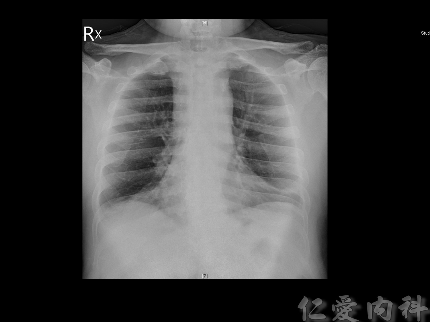 mediastinal_mass - mediastinal_mass-19.jpg