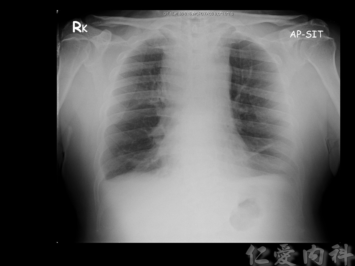 mediastinal_mass - mediastinal_mass-20.jpg