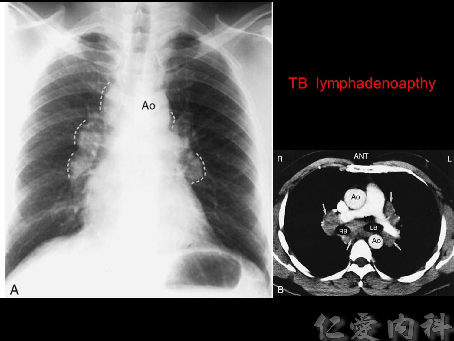 mediastinal_mass - mediastinal_mass-23.jpg