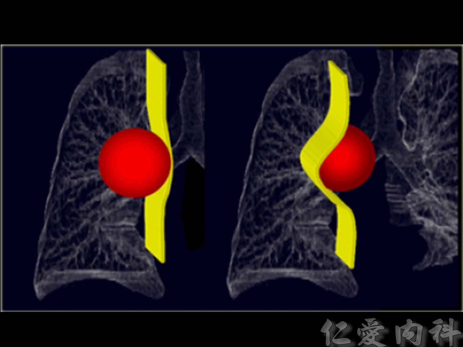 mediastinal_mass - mediastinal_mass-25.jpg