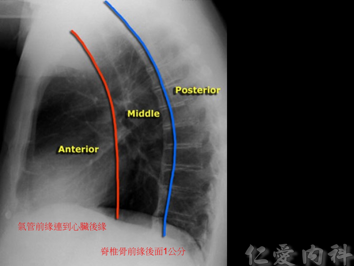 mediastinal_mass - mediastinal_mass-26.jpg