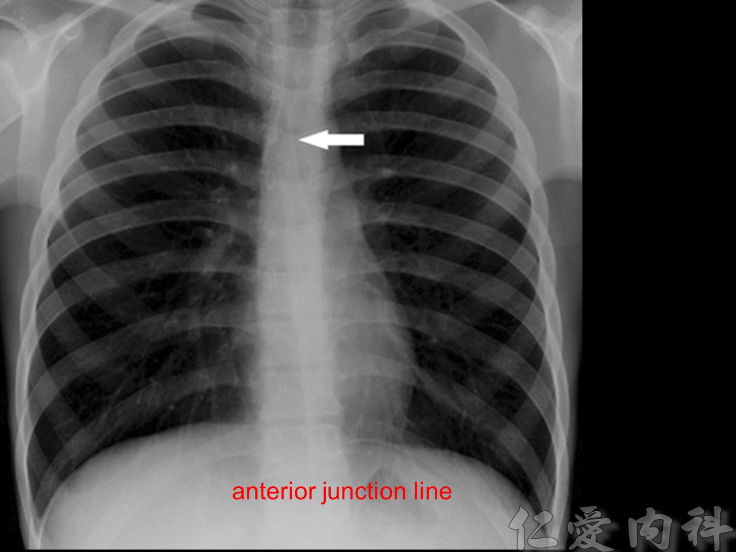 mediastinal_mass - mediastinal_mass-29.jpg