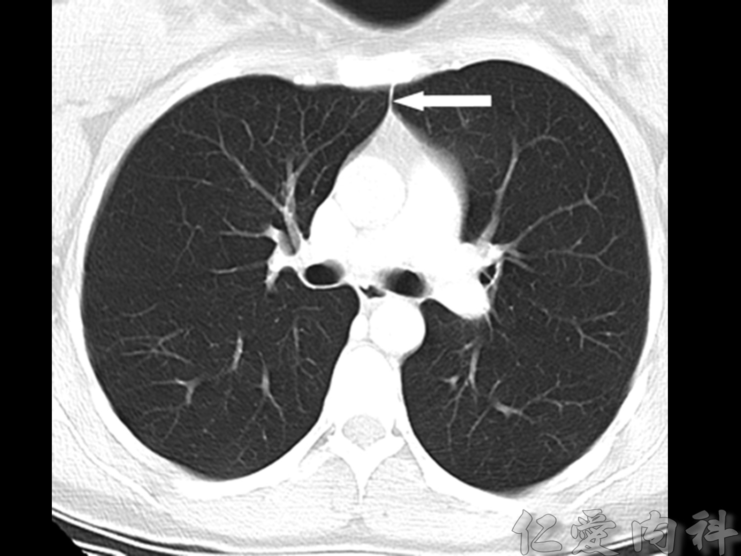 mediastinal_mass - mediastinal_mass-30.jpg