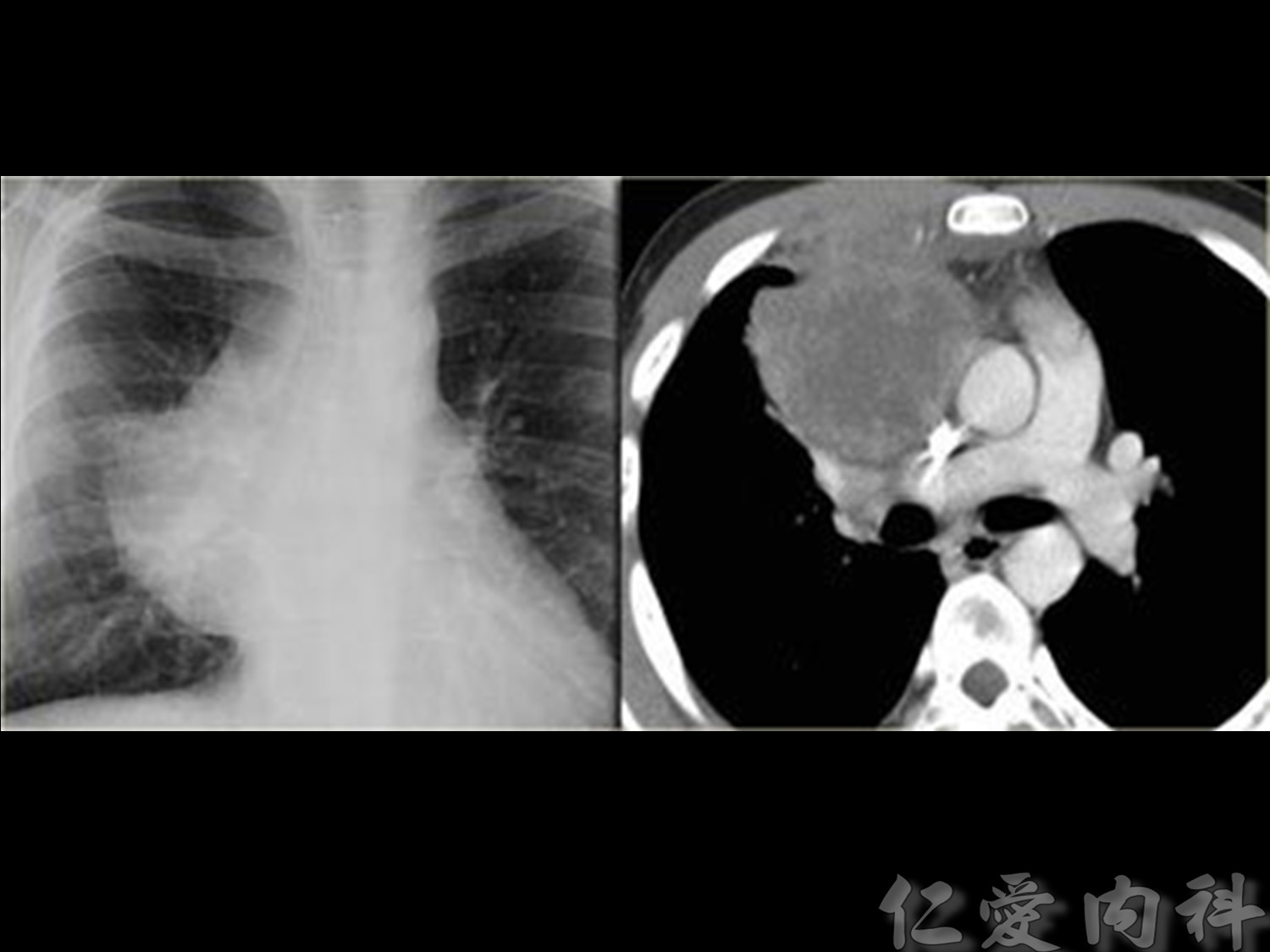 mediastinal_mass - mediastinal_mass-34.jpg