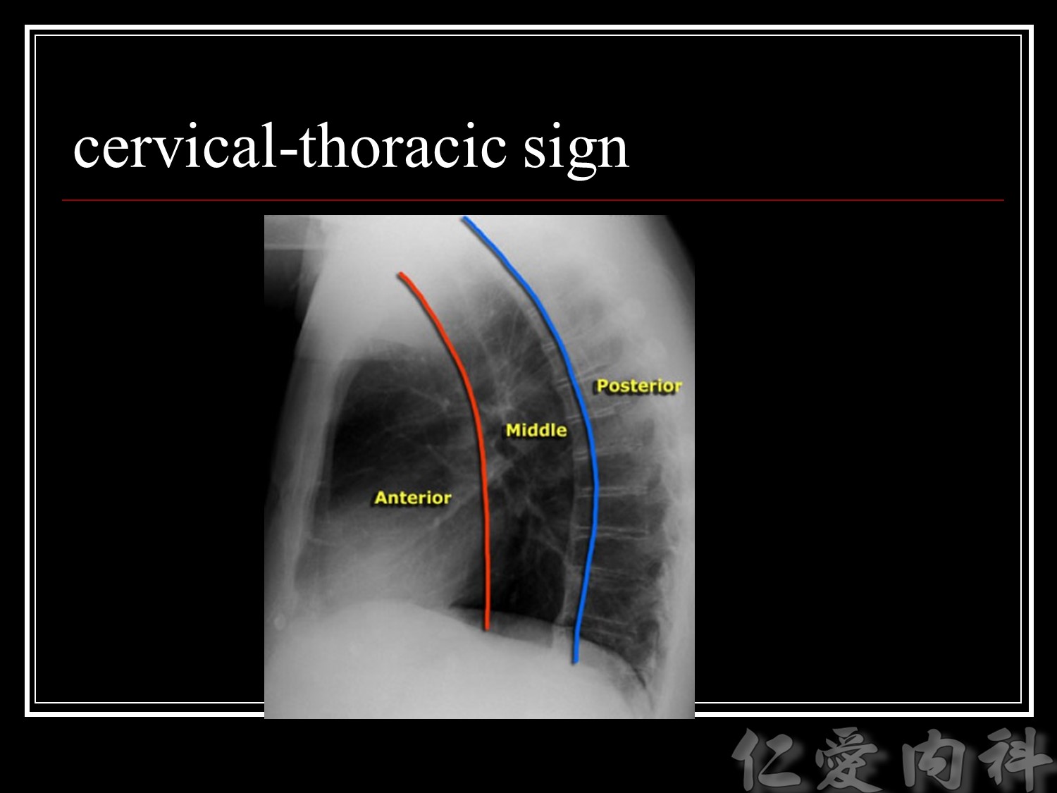 mediastinal_mass - mediastinal_mass-35.jpg