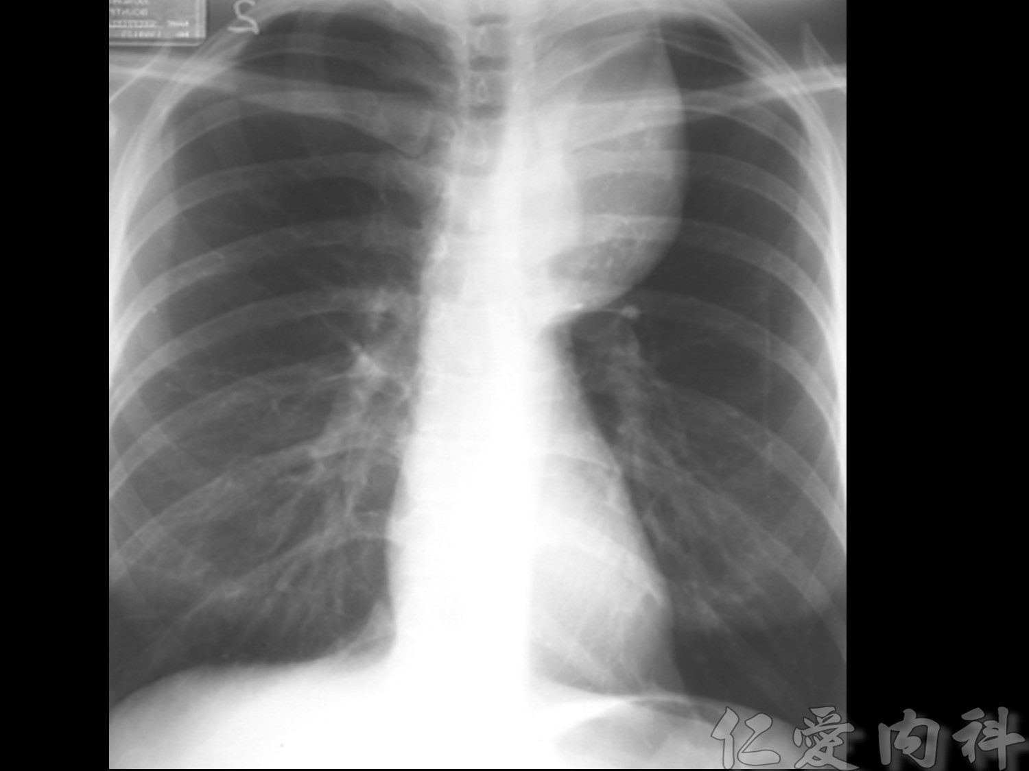 mediastinal_mass - mediastinal_mass-38.jpg