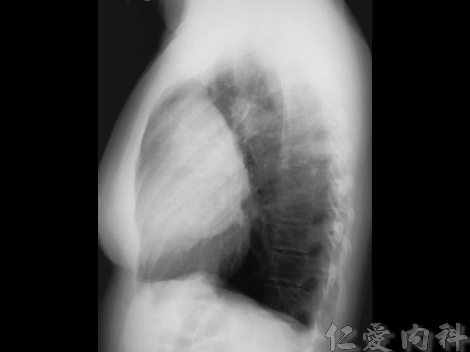 mediastinal_mass - mediastinal_mass-47.jpg