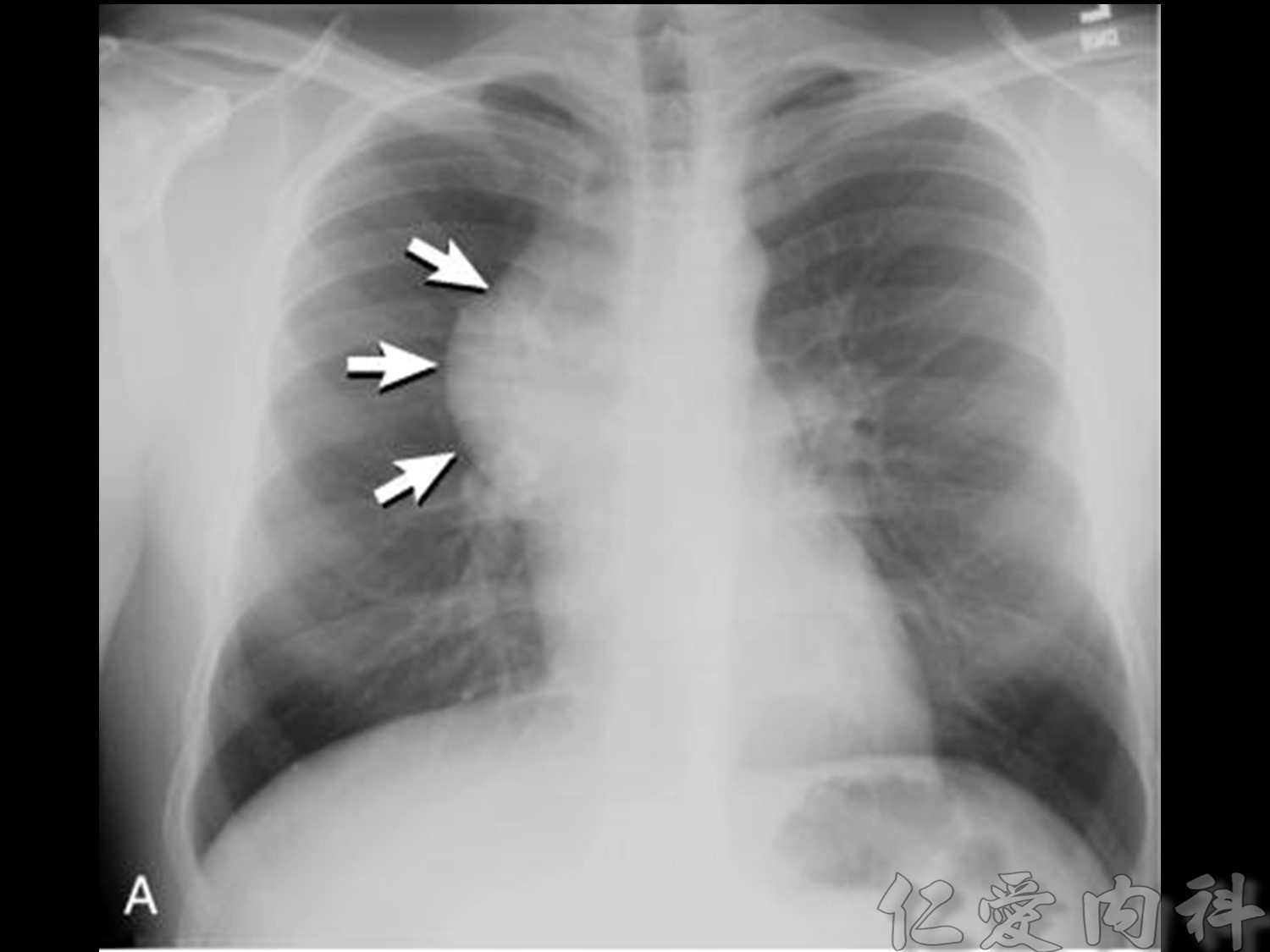 mediastinal_mass - mediastinal_mass-49.jpg