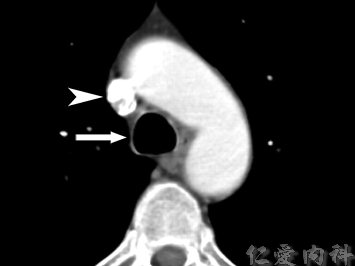 mediastinal_mass - mediastinal_mass-59.jpg