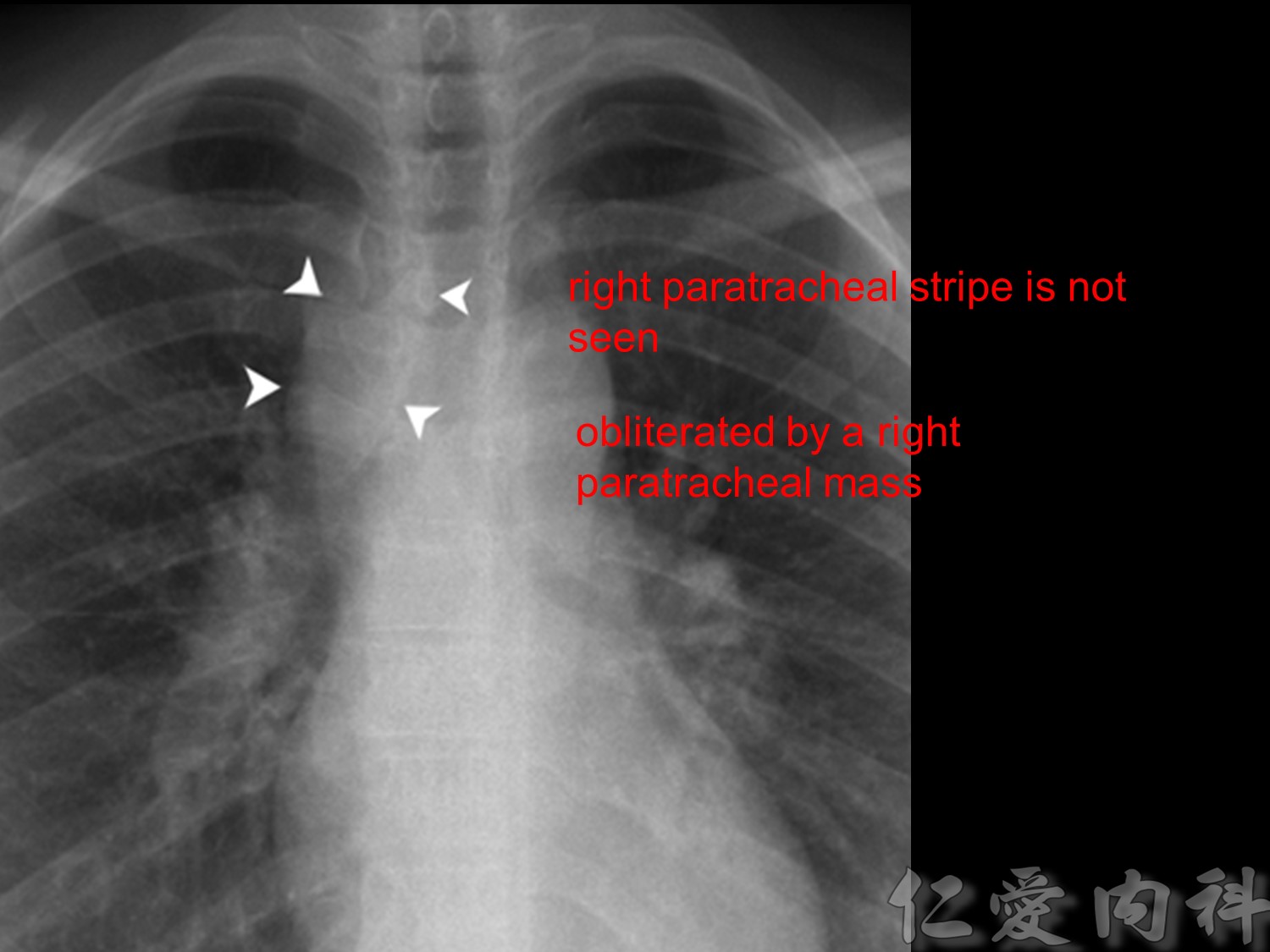 mediastinal_mass - mediastinal_mass-60.jpg