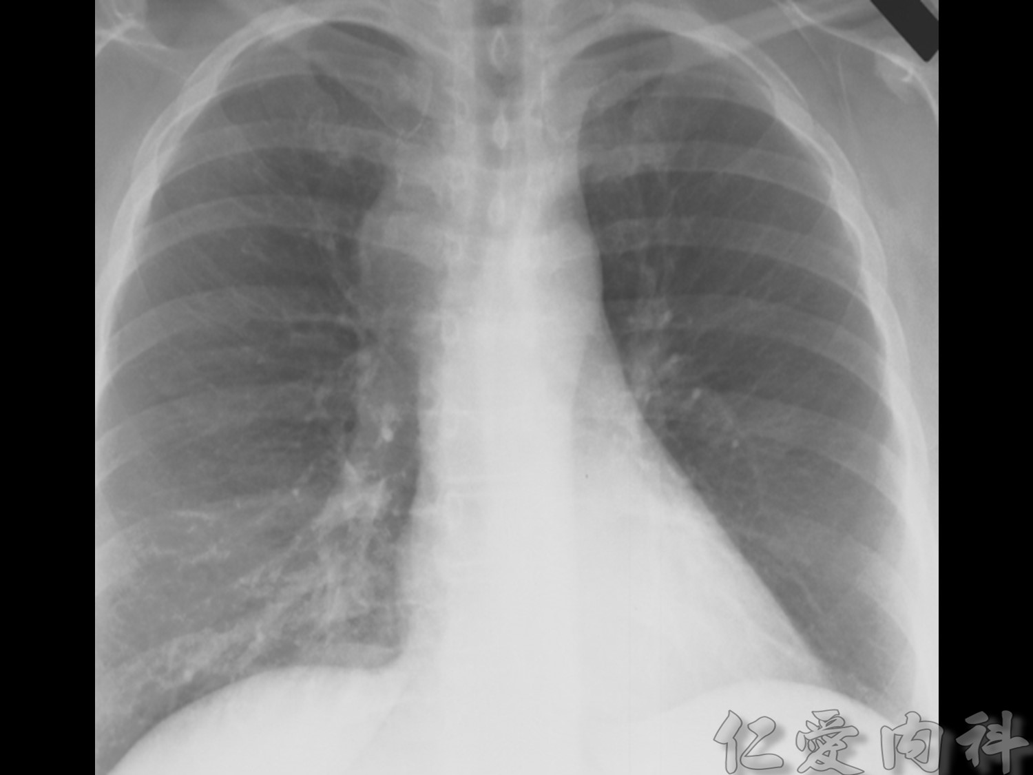 mediastinal_mass - mediastinal_mass-62.jpg