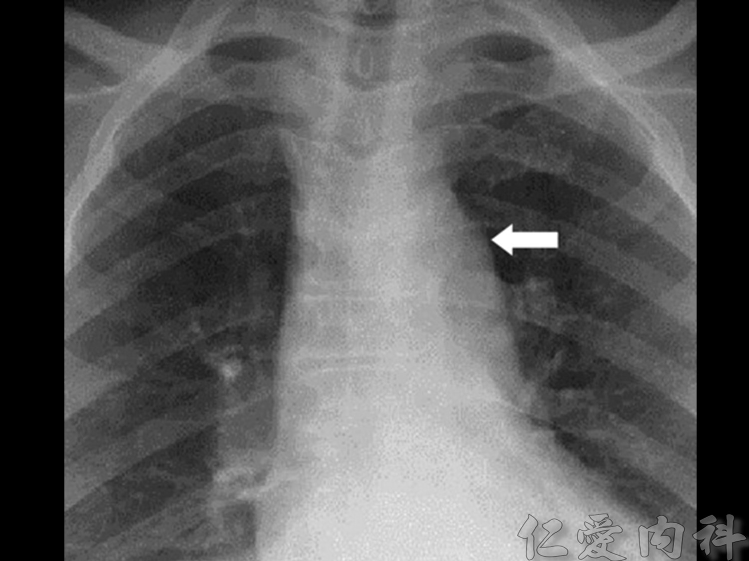 mediastinal_mass - mediastinal_mass-65.jpg