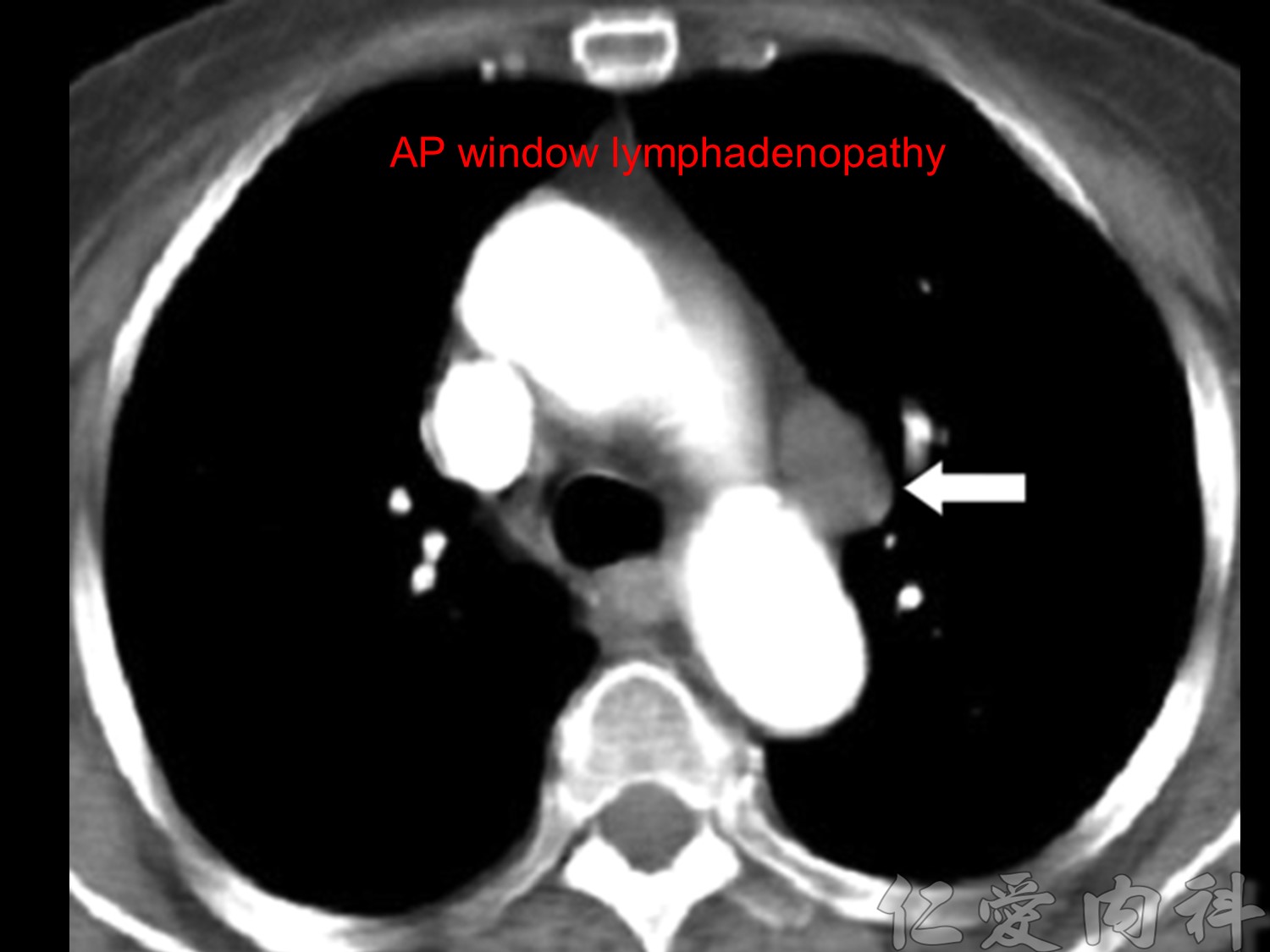 mediastinal_mass - mediastinal_mass-66.jpg