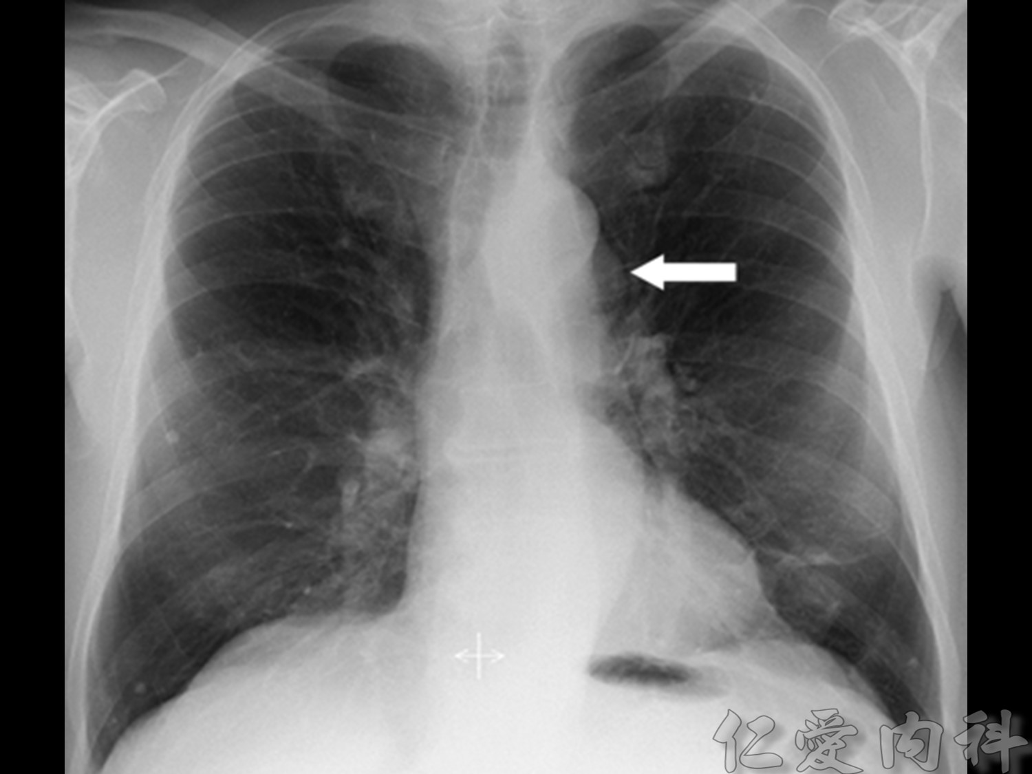 mediastinal_mass - mediastinal_mass-67.jpg