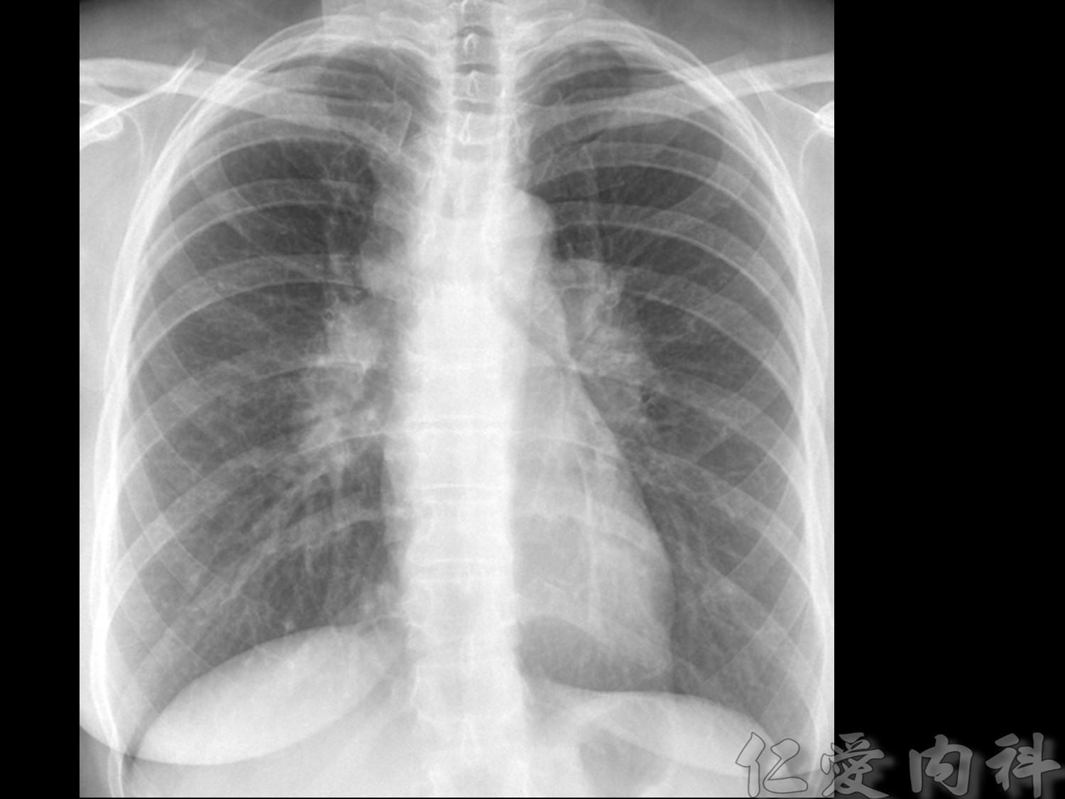 mediastinal_mass - mediastinal_mass-72.jpg