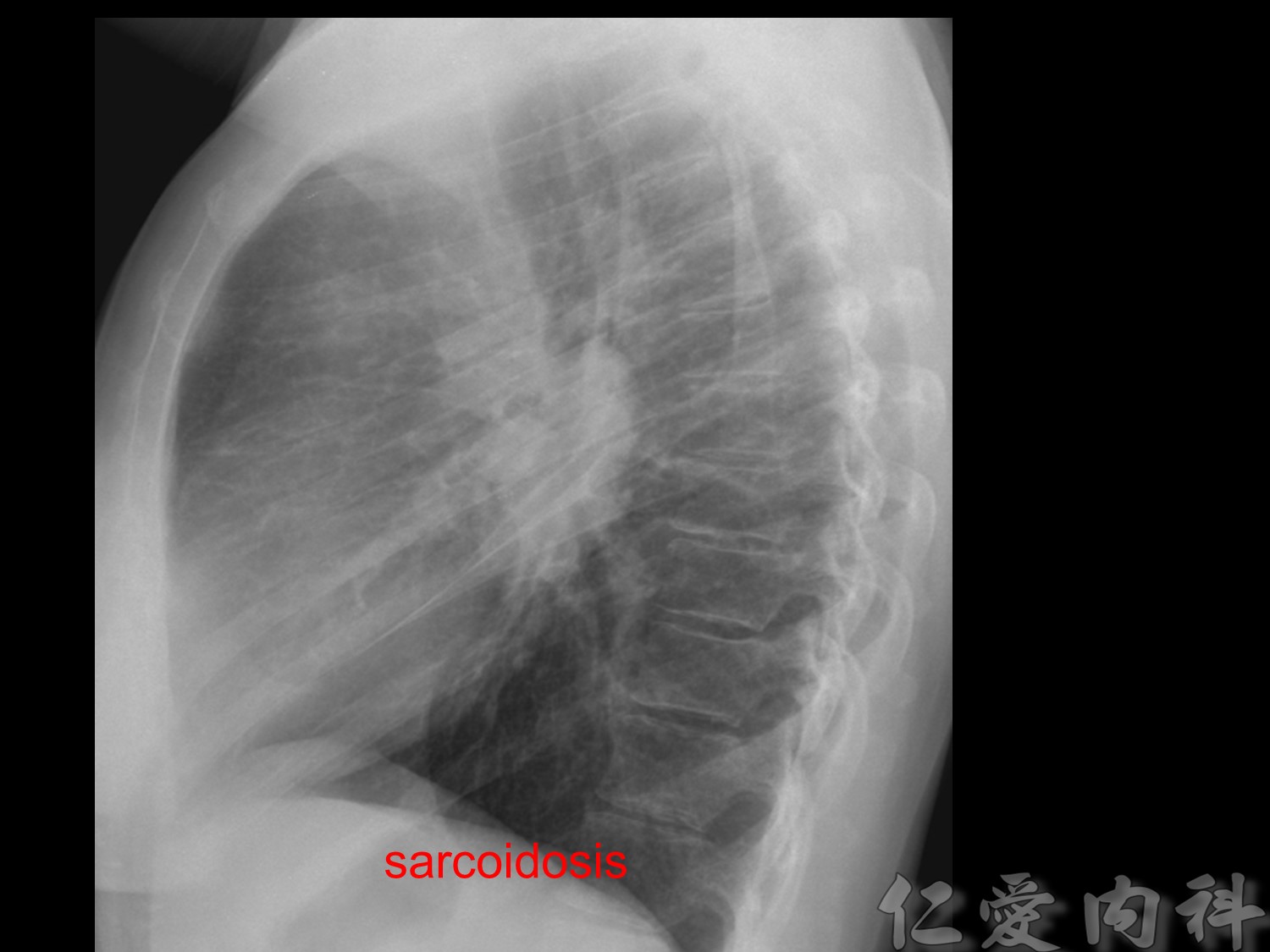 mediastinal_mass - mediastinal_mass-73.jpg