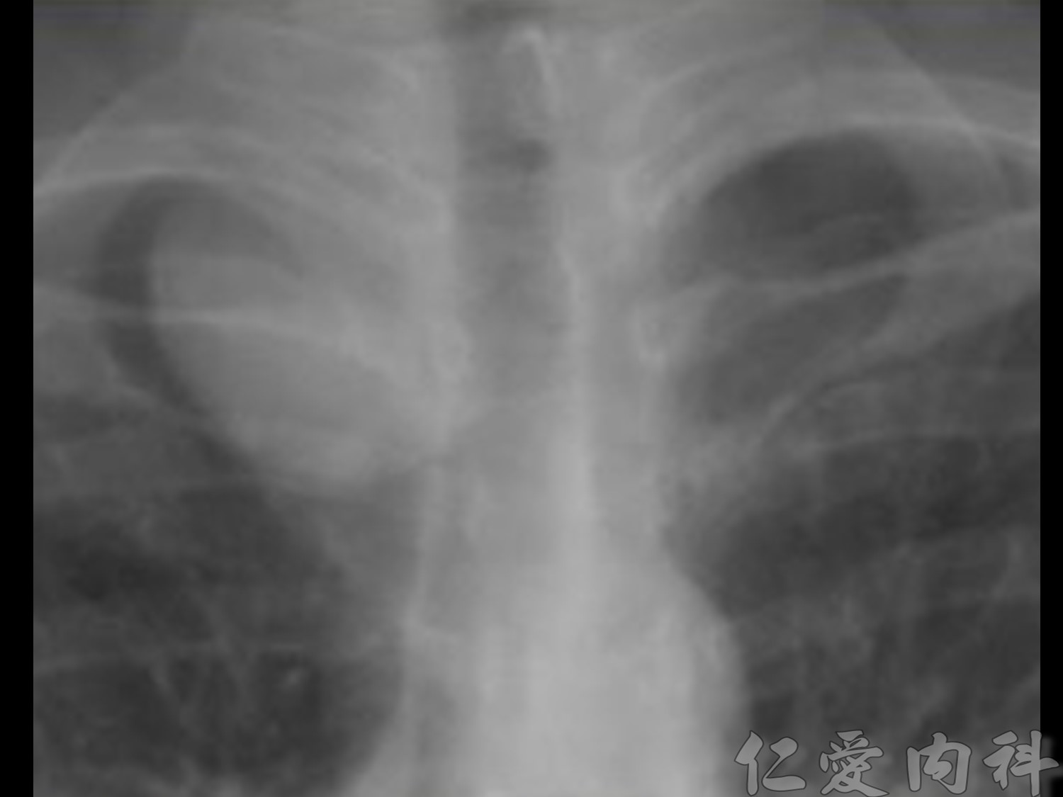 mediastinal_mass - mediastinal_mass-80.jpg