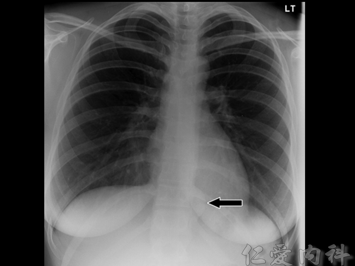 mediastinal_mass - mediastinal_mass-82.jpg