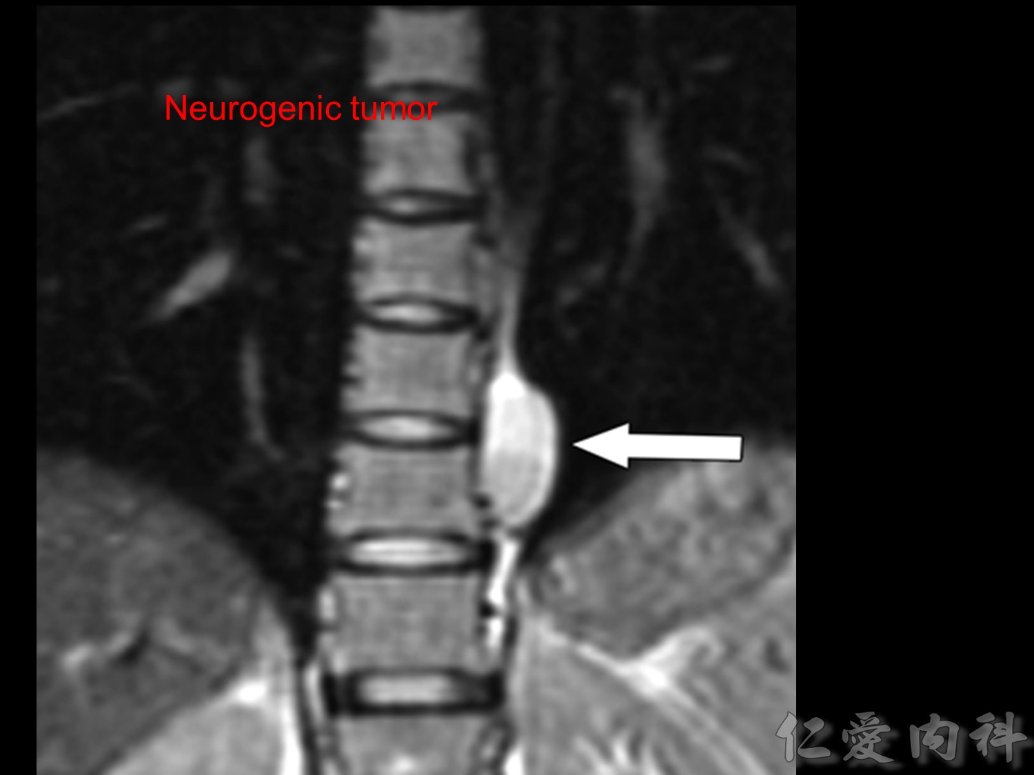 mediastinal_mass - mediastinal_mass-83.jpg