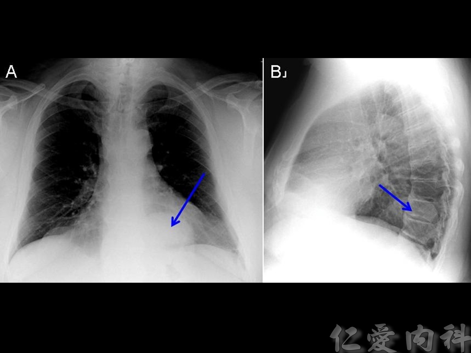 mediastinal_mass - mediastinal_mass-84.jpg