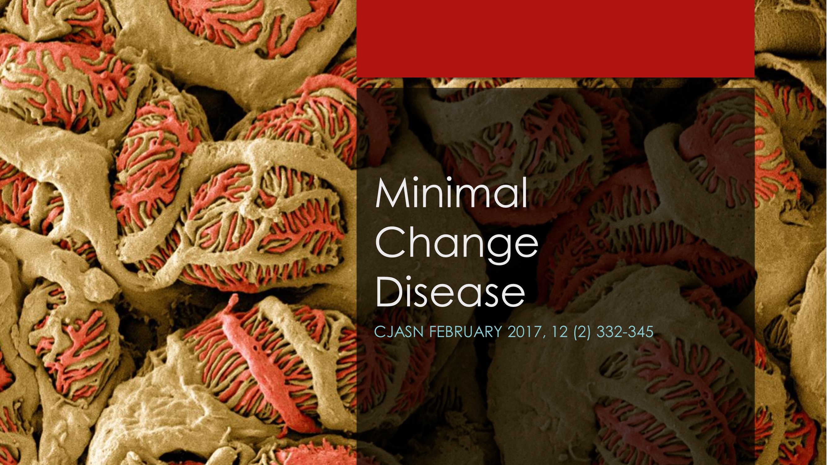 minimal-change-disease